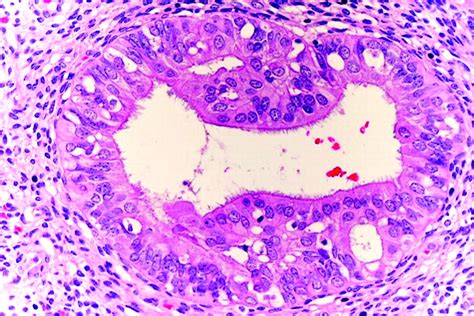 endometrial metaplasia pathology outlines